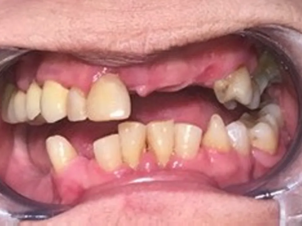 Implantes dentales: antes del tratamiento