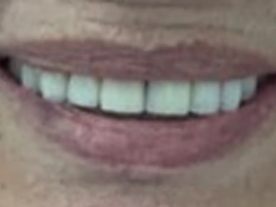 Implantes dentales: después del tratamiento