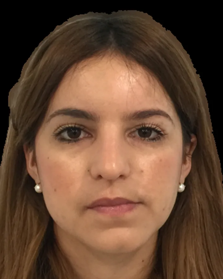 Cirugía ortognática: antes del tratamiento