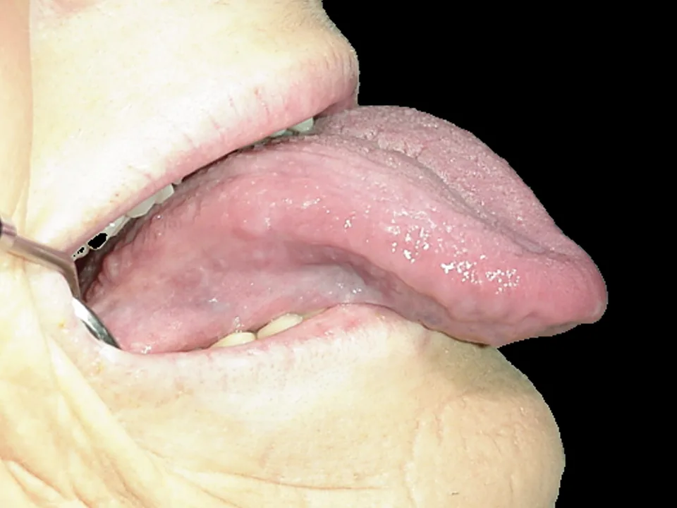 Cirugía oral: después del tratamiento