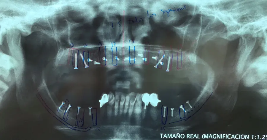 Implantes dentales: antes del tratamiento
