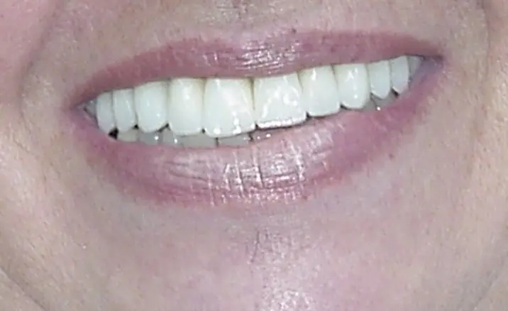 Implantes dentales: después del tratamiento