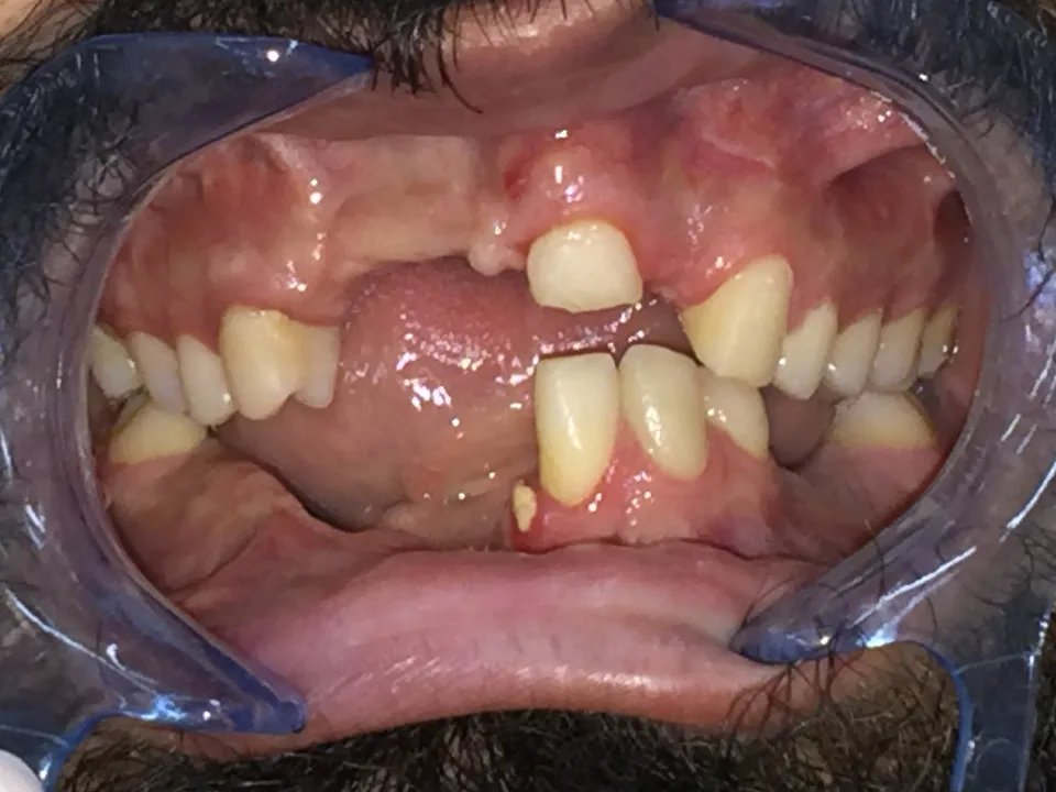 Cirugía maxilofacial e implantes dentales: antes del tratamiento
