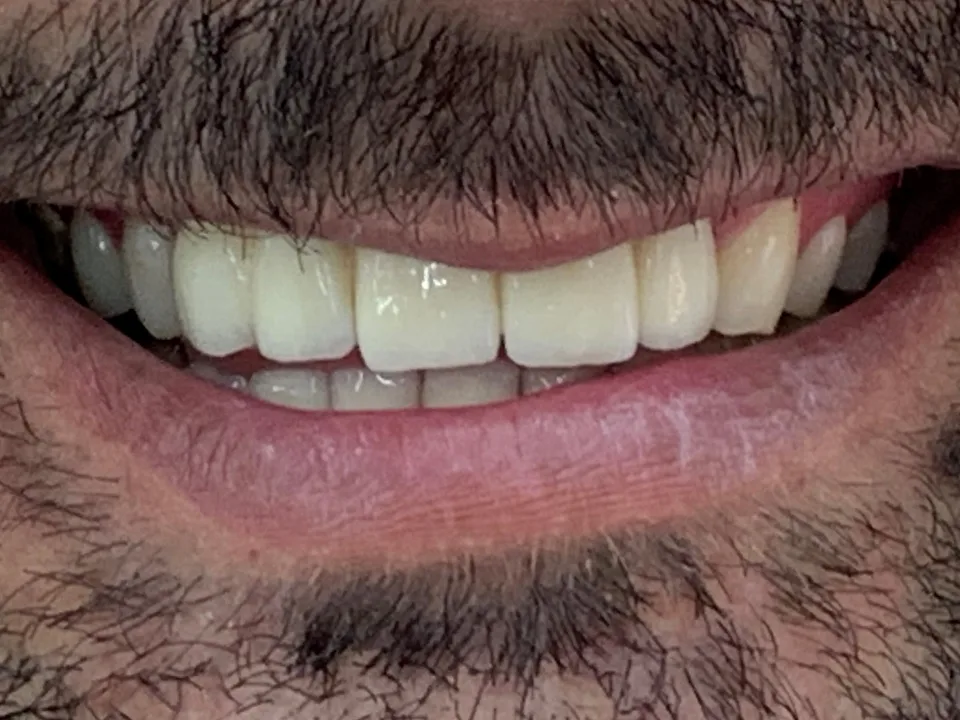 Cirugía maxilofacial e implantes dentales: después del tratamiento