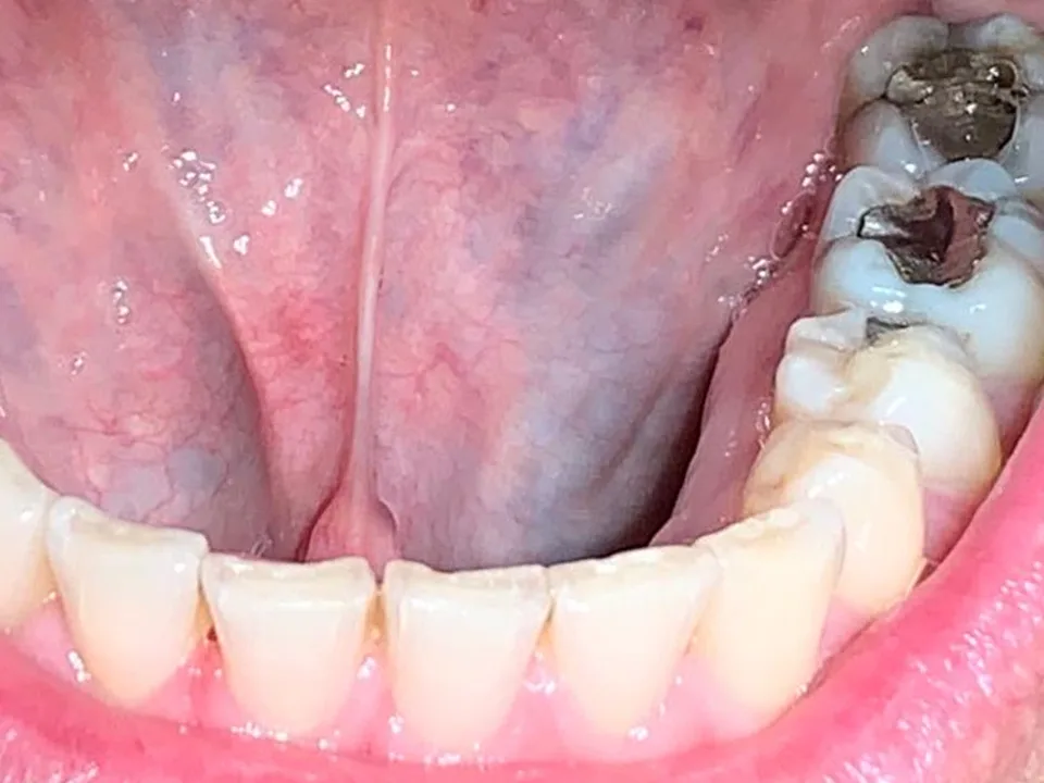 Cirugía oral: después del tratamiento